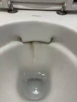 Urine steen verwijdering.jpg