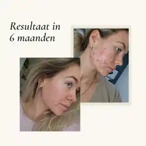 Acne resultaat in 6 maanden .jpg